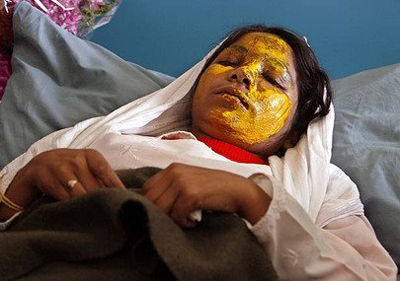 Mulher afegã vítima de ataque com ácido