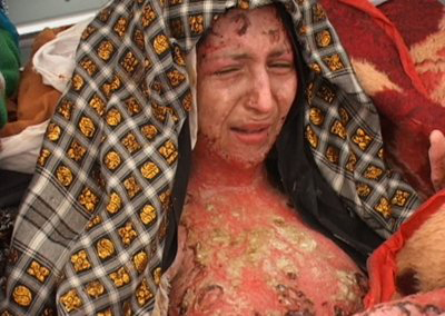 Mulher afegã com o corpo totalmente queimado